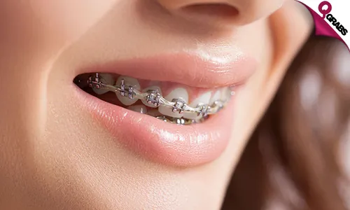 Metal Dental Braces!